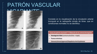 10cm
PATRÓN VASCULAR
VICARIANTE
20
Ref X-Ray Exp /
Consiste en la visualización de la circulación arterial
bronquial en la radiografía simple de tórax, que en
condiciones normales no se identifica.
 