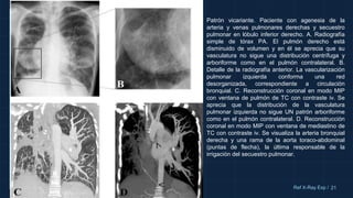 10cm 21
Ref X-Ray Exp /
Patrón vicariante. Paciente con agenesia de la
arteria y venas pulmonares derechas y secuestro
pulmonar en lóbulo inferior derecho. A. Radiografía
simple de tórax PA. El pulmón derecho está
disminuido de volumen y en él se aprecia que su
vasculatura no sigue una distribución centrífuga y
arboriforme como en el pulmón contralateral. B.
Detalle de la radiografía anterior. La vascularización
pulmonar izquierda conforma una red
desorganizada, correspondiente a circulación
bronquial. C. Reconstrucción coronal en modo MIP
con ventana de pulmón de TC con contraste iv. Se
aprecia que la distribución de la vasculatura
pulmonar izquierda no sigue UN patrón arboriforme
como en el pulmón contralateral. D. Reconstrucción
coronal en modo MIP con ventana de mediastino de
TC con contraste iv. Se visualiza la arteria bronquial
derecha y una rama de la aorta toraco-abdominal
(puntas de flecha), la última responsable de la
irrigación del secuestro pulmonar.
 