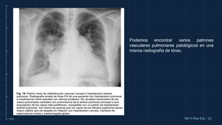 10cm 23
Ref X-Ray Exp /
Podemos encontrar varios patrones
vasculares pulmonares patológicos en una
misma radiografía de tórax.
 
