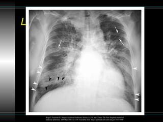 Patron reticular en la radiografía de torax | PPTX