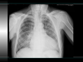 Patron reticular en la radiografía de torax | PPTX