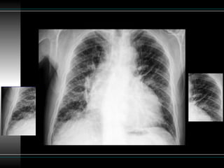 Patron reticular en la radiografía de torax | PPTX