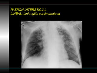 Linfangitis Reticular Patron reticular en la radiografía de torax | PPTX