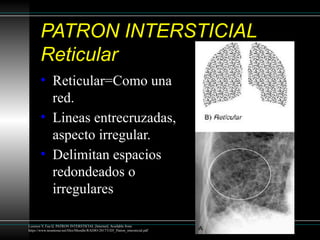 Patron reticular en la radiografía de torax | PPTX