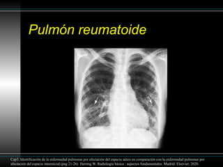 Patron reticular en la radiografía de torax | PPTX
