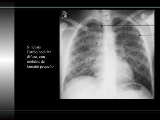 Patron reticular en la radiografía de torax | PPTX