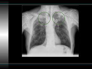 Patron reticular en la radiografía de torax | PPTX