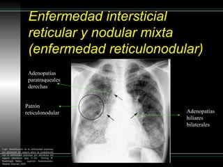 Patron reticular en la radiografía de torax | PPTX
