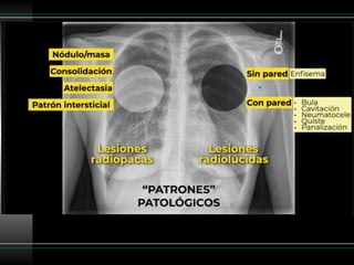 Patron reticular en la radiografía de torax | PPTX