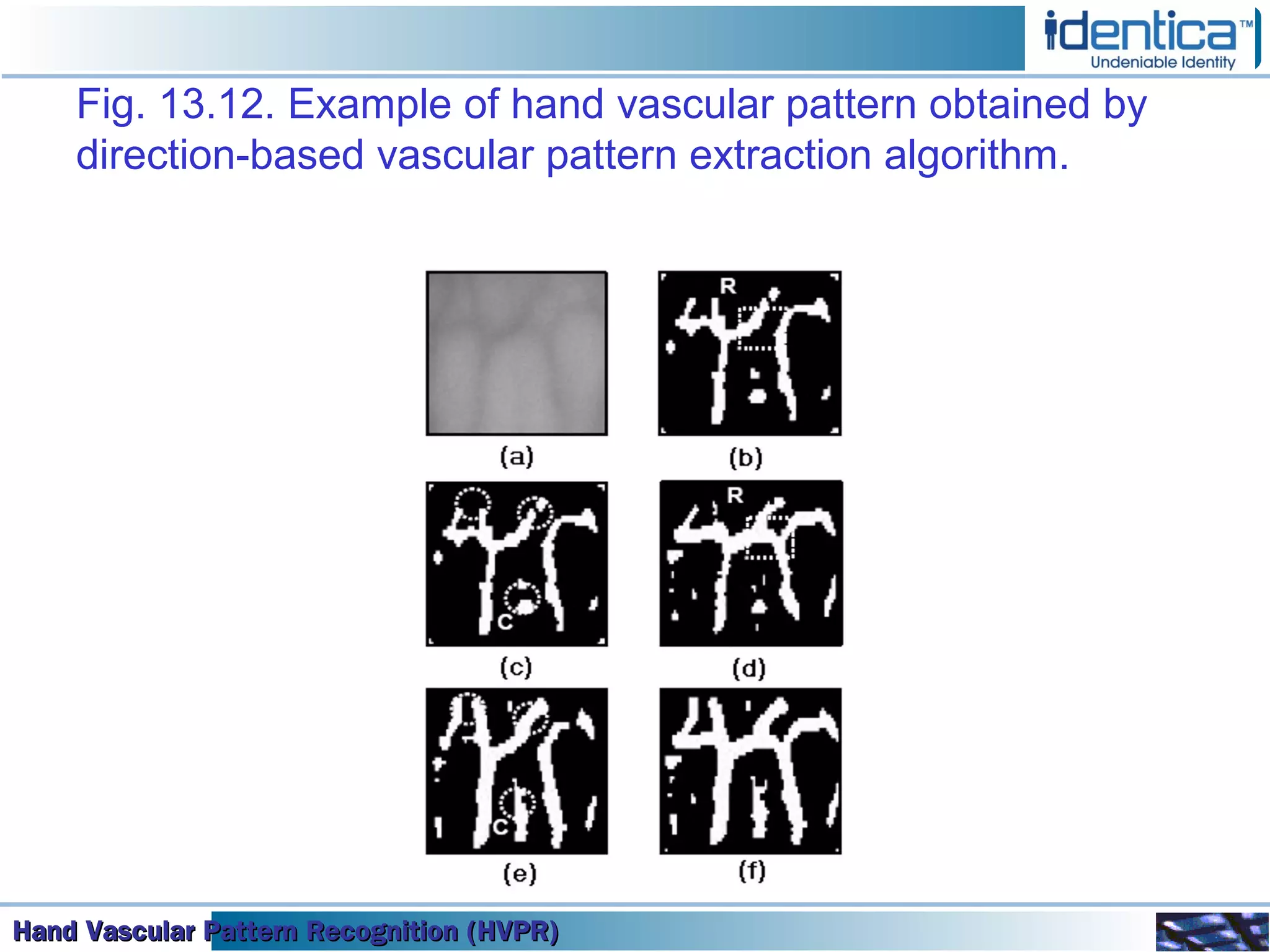 Hand Vascular Pattern Recognition (HVPR)Hand Vascular Pattern Recognition (HVPR)Hand Vascular Pattern Recognition (HVPR)Hand Vascular Pattern Recognition (HVPR)
Fig. 13.12. Example of hand vascular pattern obtained by
direction-based vascular pattern extraction algorithm.
 