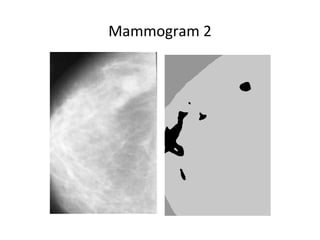Pattern recognition in medical images | PPT