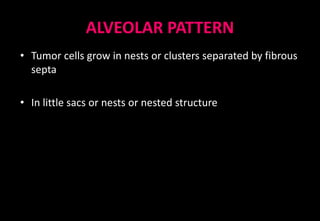 ALVEOLAR PATTERN
• Tumor cells grow in nests or clusters separated by fibrous
septa
• In little sacs or nests or nested structure
 