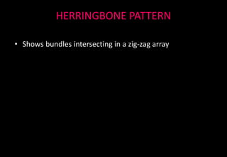 HERRINGBONE PATTERN
• Shows bundles intersecting in a zig-zag array
 