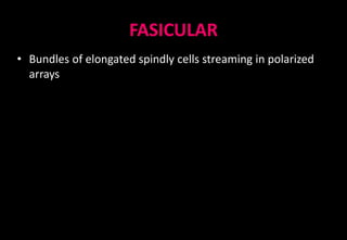 FASICULAR
• Bundles of elongated spindly cells streaming in polarized
arrays
 