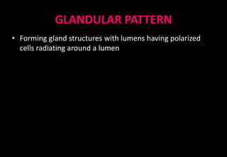 GLANDULAR PATTERN
• Forming gland structures with lumens having polarized
cells radiating around a lumen
 
