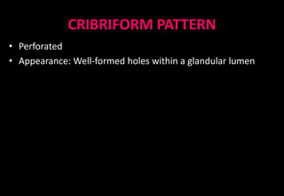 CRIBRIFORM PATTERN
• Perforated
• Appearance: Well-formed holes within a glandular lumen
 