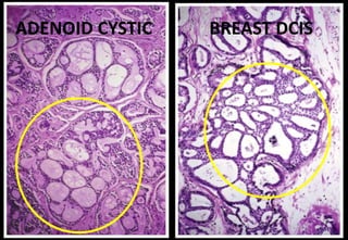 ADENOID CYSTIC BREAST DCIS
 