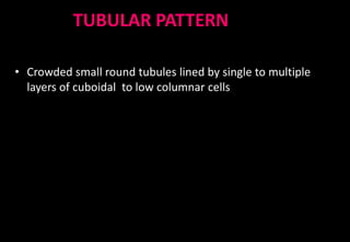 TUBULAR PATTERN
• Crowded small round tubules lined by single to multiple
layers of cuboidal to low columnar cells
 