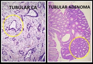 TUBULAR CA TUBULAR ADENOMA
 