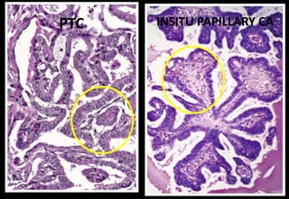 PTC INSITU PAPILLARY CA
 