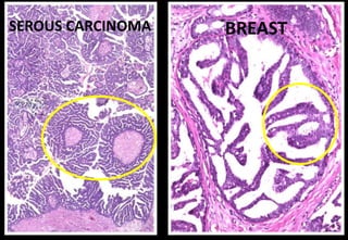 SEROUS CARCINOMA BREAST
 