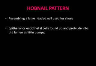HOBNAIL PATTERN
• Resembling a large headed nail used for shoes
• Epithelial or endothelial cells round up and protrude into
the lumen as little bumps.
 