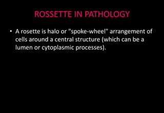 ROSSETTE IN PATHOLOGY
• A rosette is halo or "spoke-wheel" arrangement of
cells around a central structure (which can be a
lumen or cytoplasmic processes).
 
