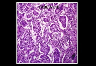 CARCINOID
 