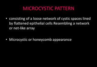 MICROCYSTIC PATTERN
• consisting of a loose network of cystic spaces lined
by flattened epithelial cells Resembling a network
or net-like array
• Microcystic or honeycomb appearance
 