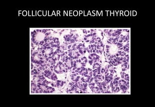 FOLLICULAR NEOPLASM THYROID
 
