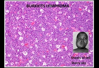 Sheets of cell
Starry sky
BURKKITS LYMPHOMA
 