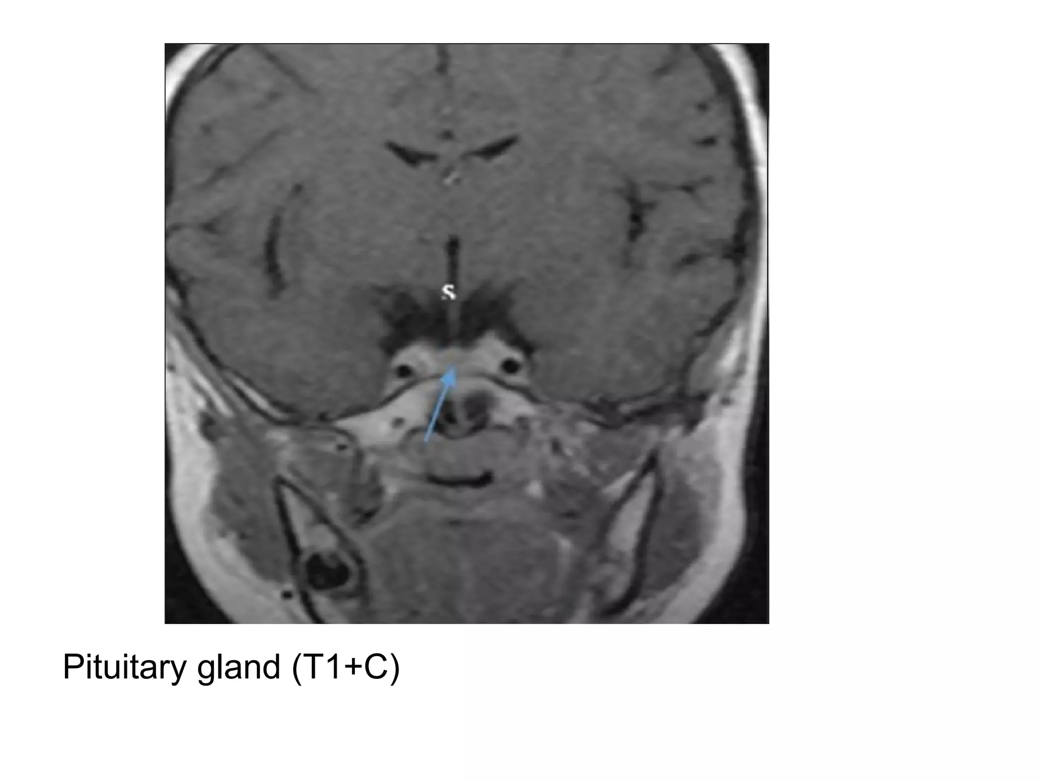 Pituitary gland (T1+C)
 