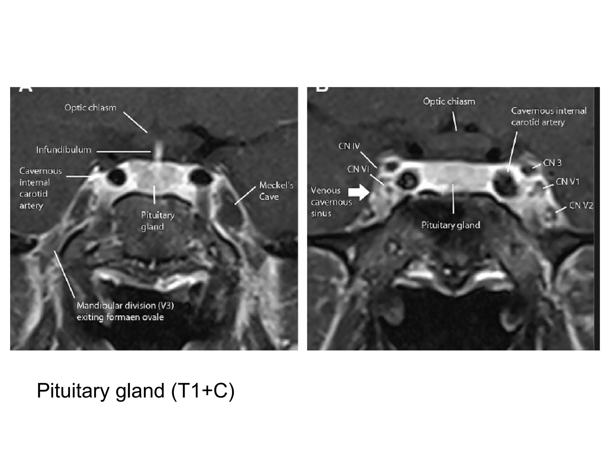 Pituitary gland (T1+C)
 