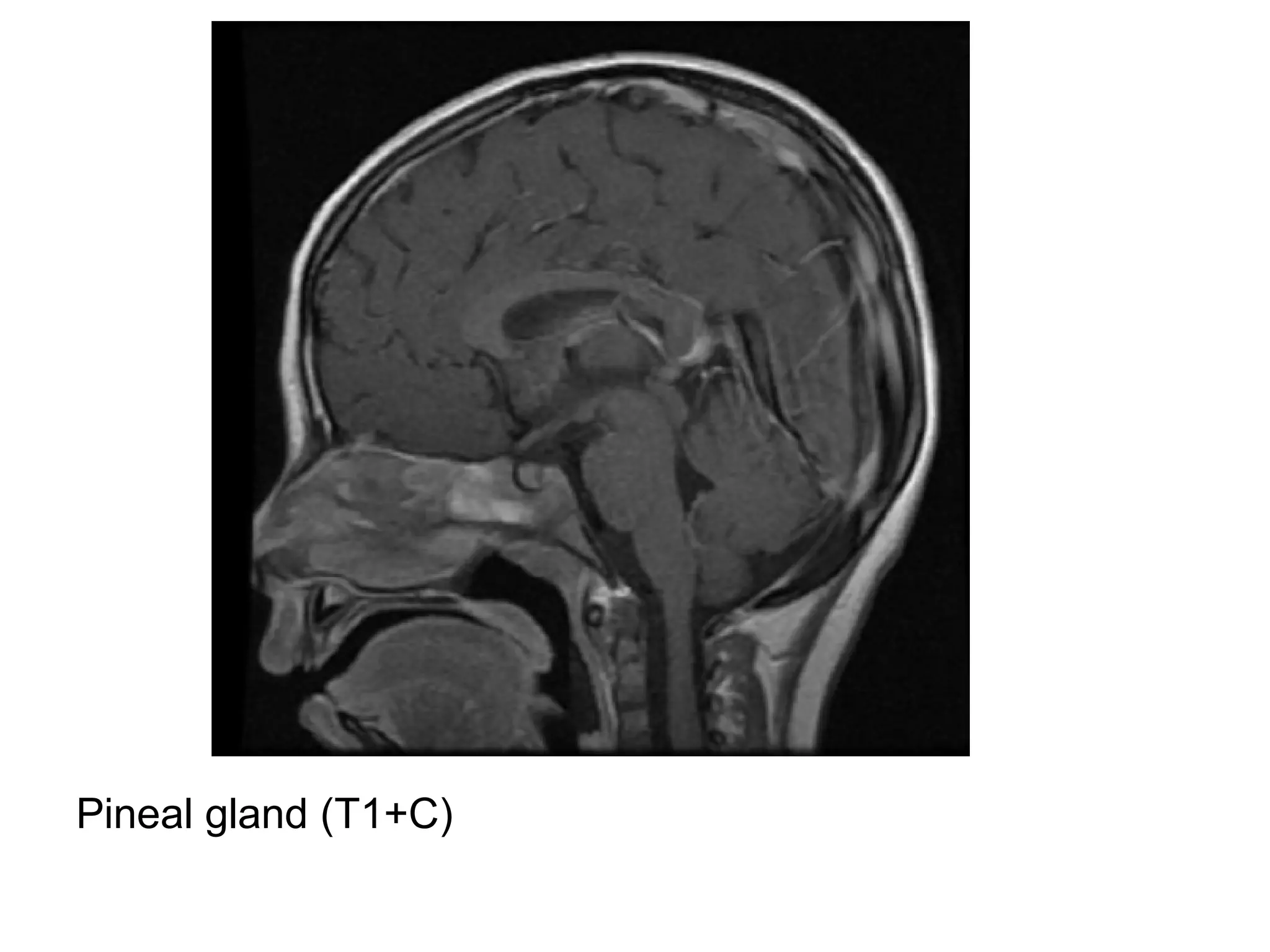 Pineal gland (T1+C)
 