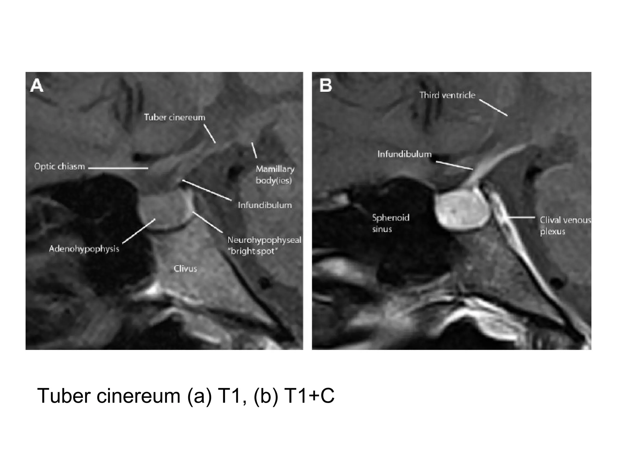Tuber cinereum (a) T1, (b) T1+C
 