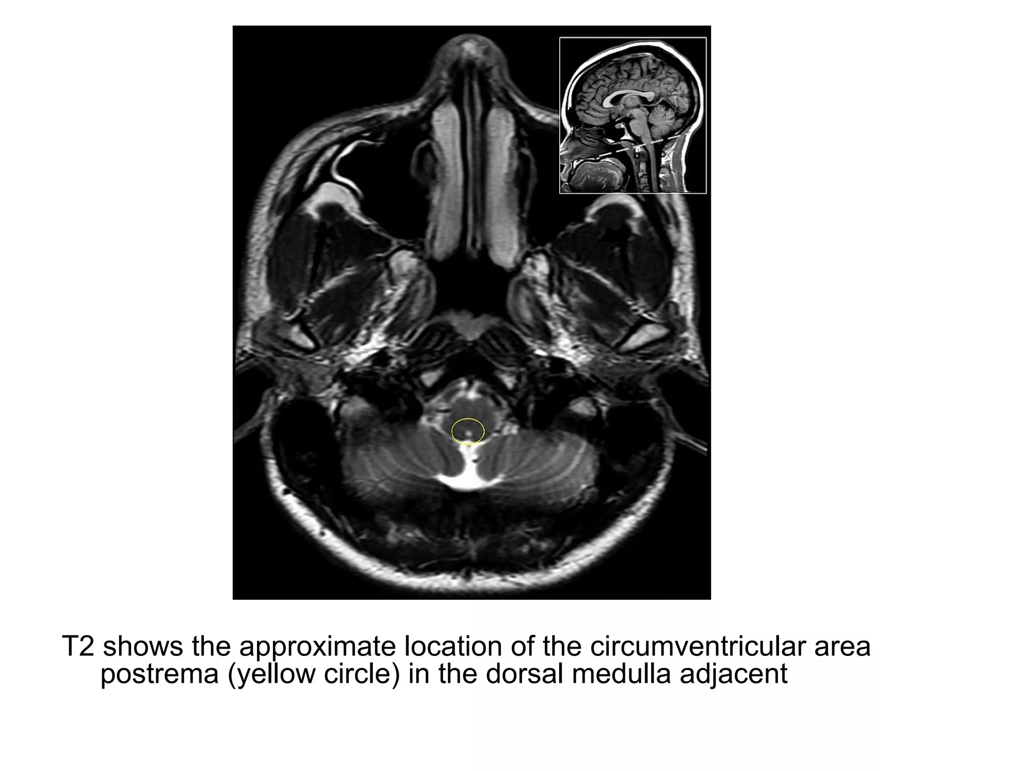 T2 shows the approximate location of the circumventricular area
postrema (yellow circle) in the dorsal medulla adjacent
 