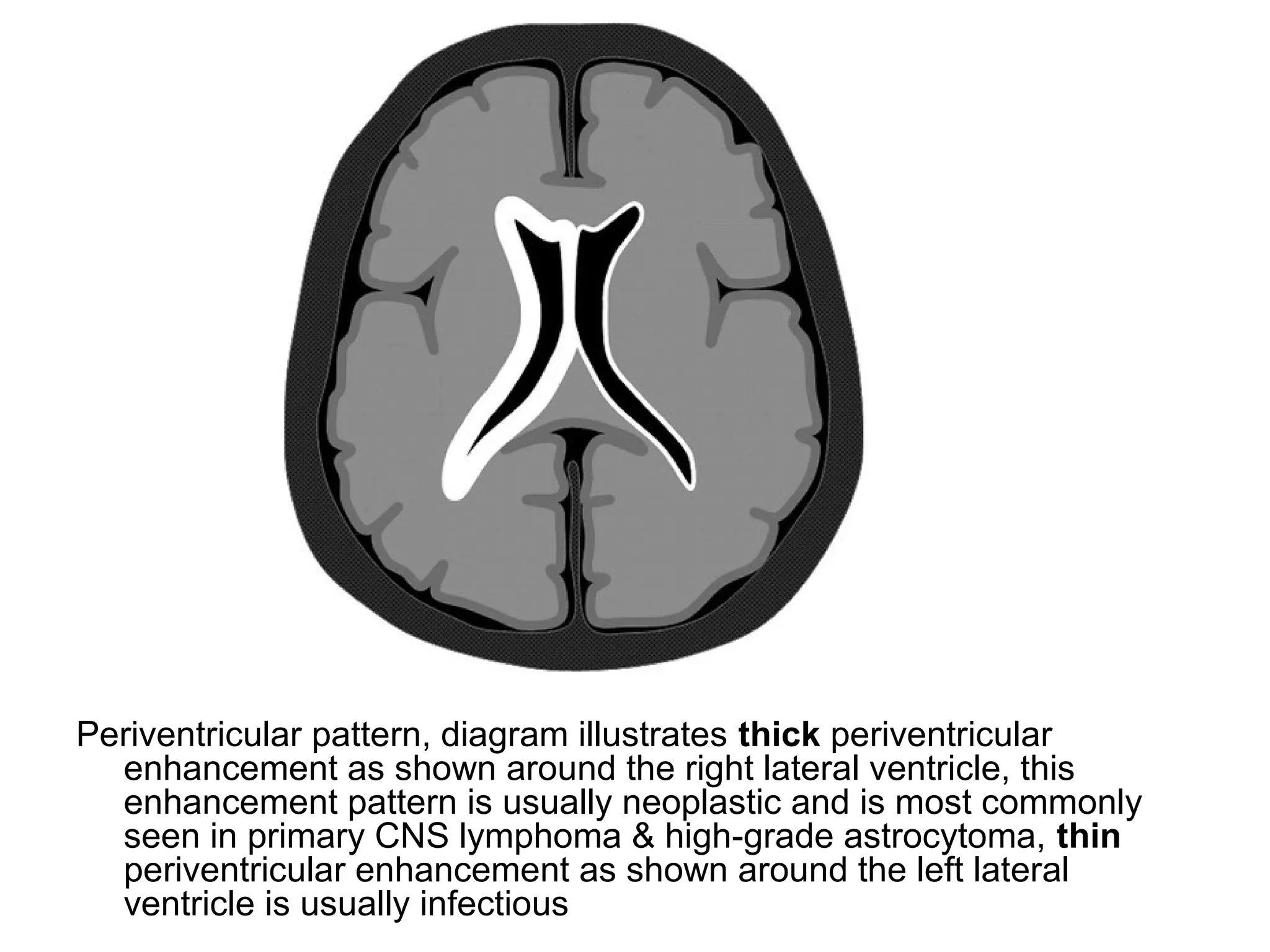 Periventricular pattern, diagram illustrates thick periventricular
enhancement as shown around the right lateral ventricle, this
enhancement pattern is usually neoplastic and is most commonly
seen in primary CNS lymphoma & high-grade astrocytoma, thin
periventricular enhancement as shown around the left lateral
ventricle is usually infectious
 