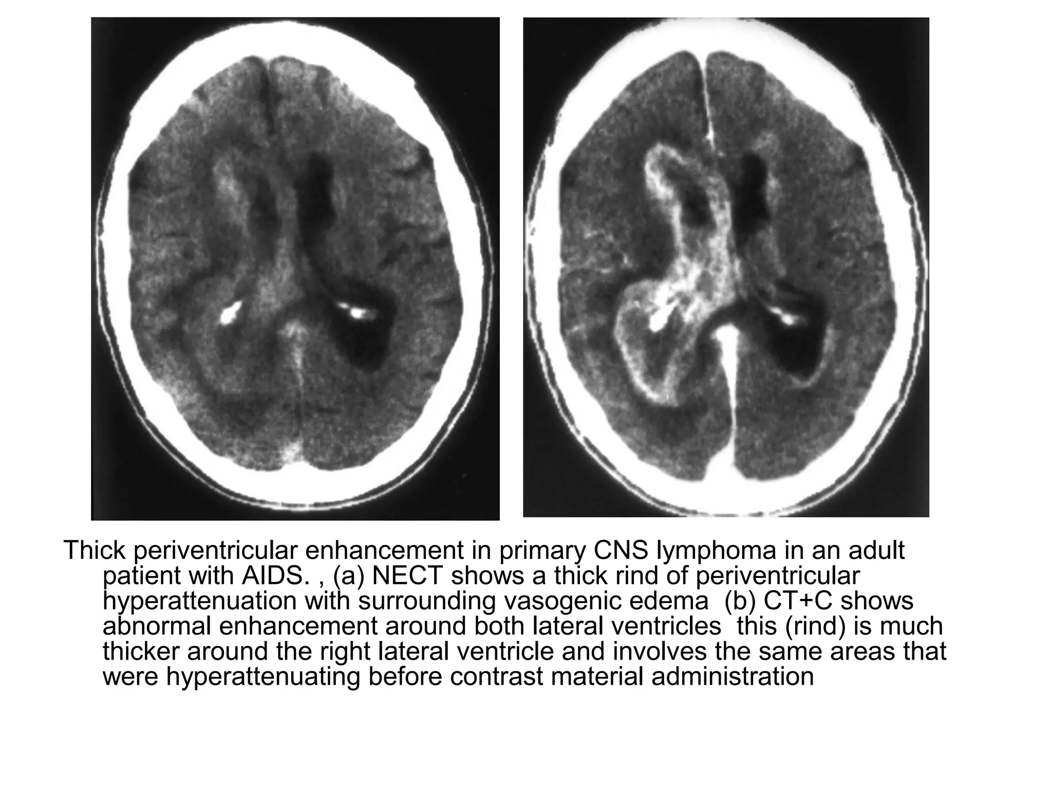 Thick periventricular enhancement in primary CNS lymphoma in an adult
patient with AIDS. , (a) NECT shows a thick rind of periventricular
hyperattenuation with surrounding vasogenic edema (b) CT+C shows
abnormal enhancement around both lateral ventricles this (rind) is much
thicker around the right lateral ventricle and involves the same areas that
were hyperattenuating before contrast material administration
 