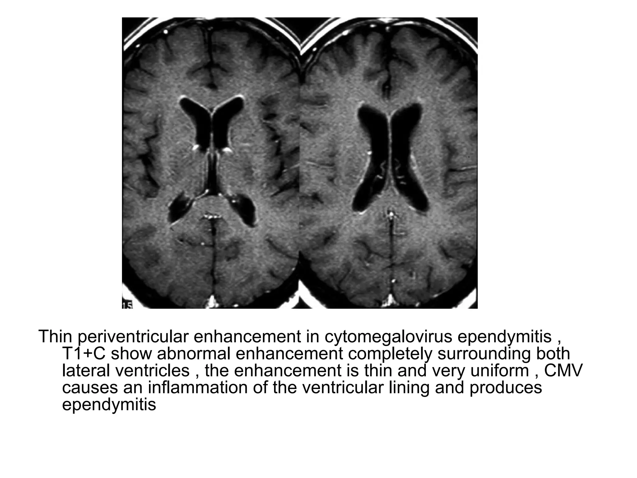 Thin periventricular enhancement in cytomegalovirus ependymitis ,
T1+C show abnormal enhancement completely surrounding both
lateral ventricles , the enhancement is thin and very uniform , CMV
causes an inflammation of the ventricular lining and produces
ependymitis
 