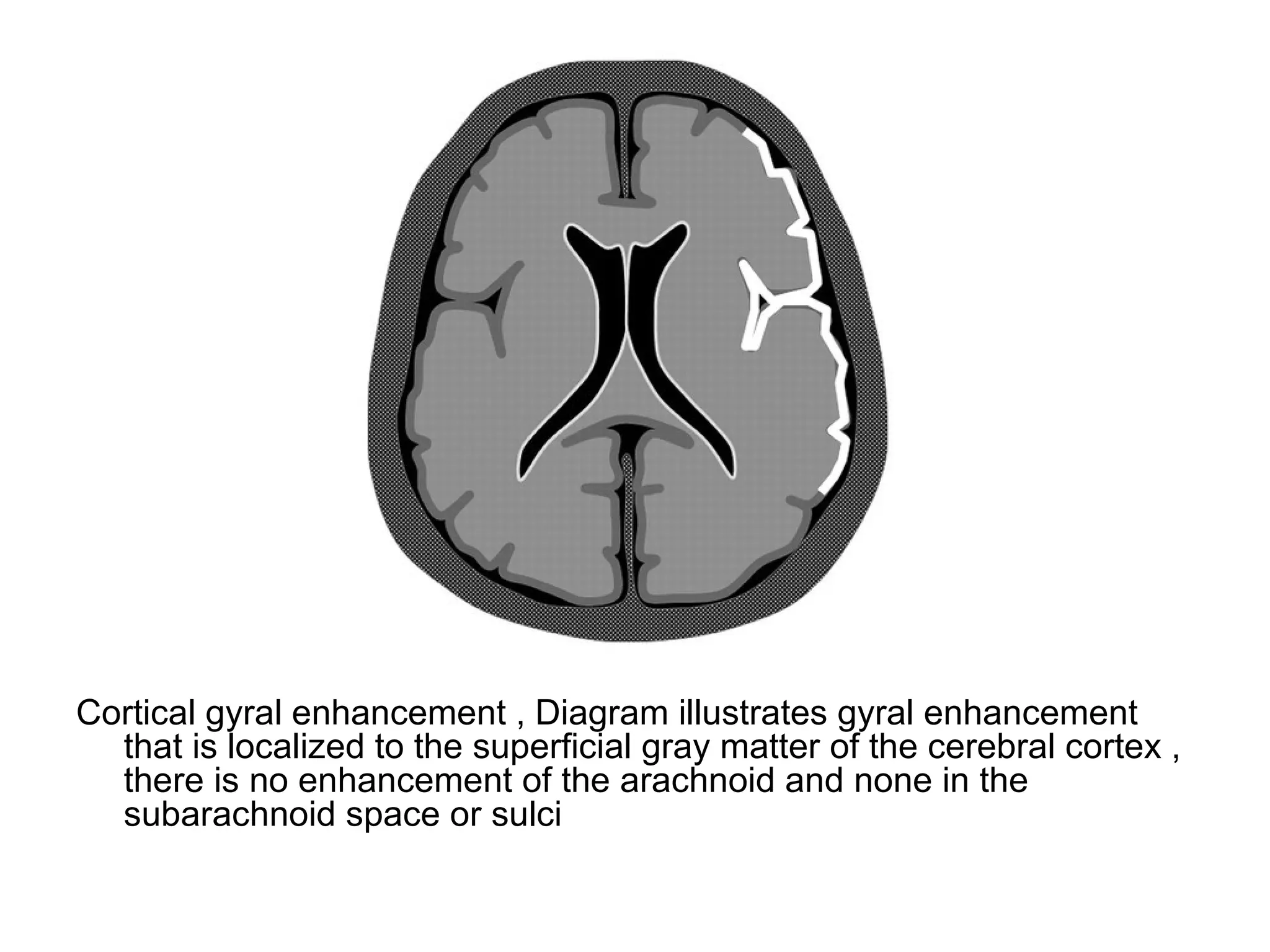 Cortical gyral enhancement , Diagram illustrates gyral enhancement
that is localized to the superficial gray matter of the cerebral cortex ,
there is no enhancement of the arachnoid and none in the
subarachnoid space or sulci
 