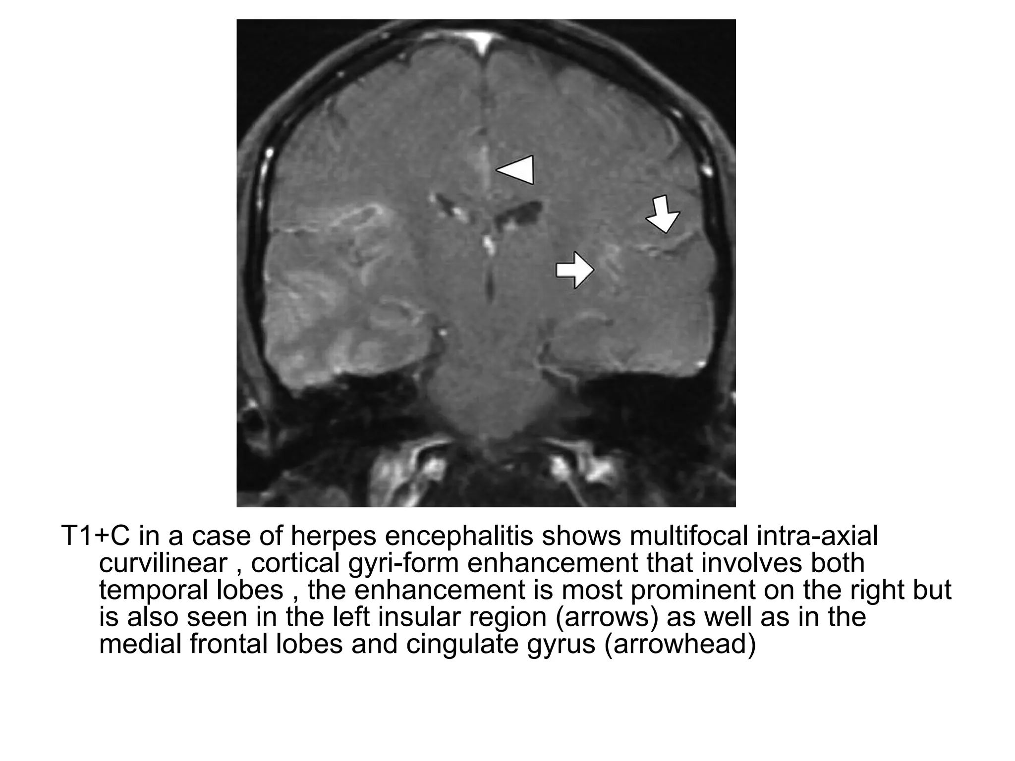 T1+C in a case of herpes encephalitis shows multifocal intra-axial
curvilinear , cortical gyri-form enhancement that involves both
temporal lobes , the enhancement is most prominent on the right but
is also seen in the left insular region (arrows) as well as in the
medial frontal lobes and cingulate gyrus (arrowhead)
 