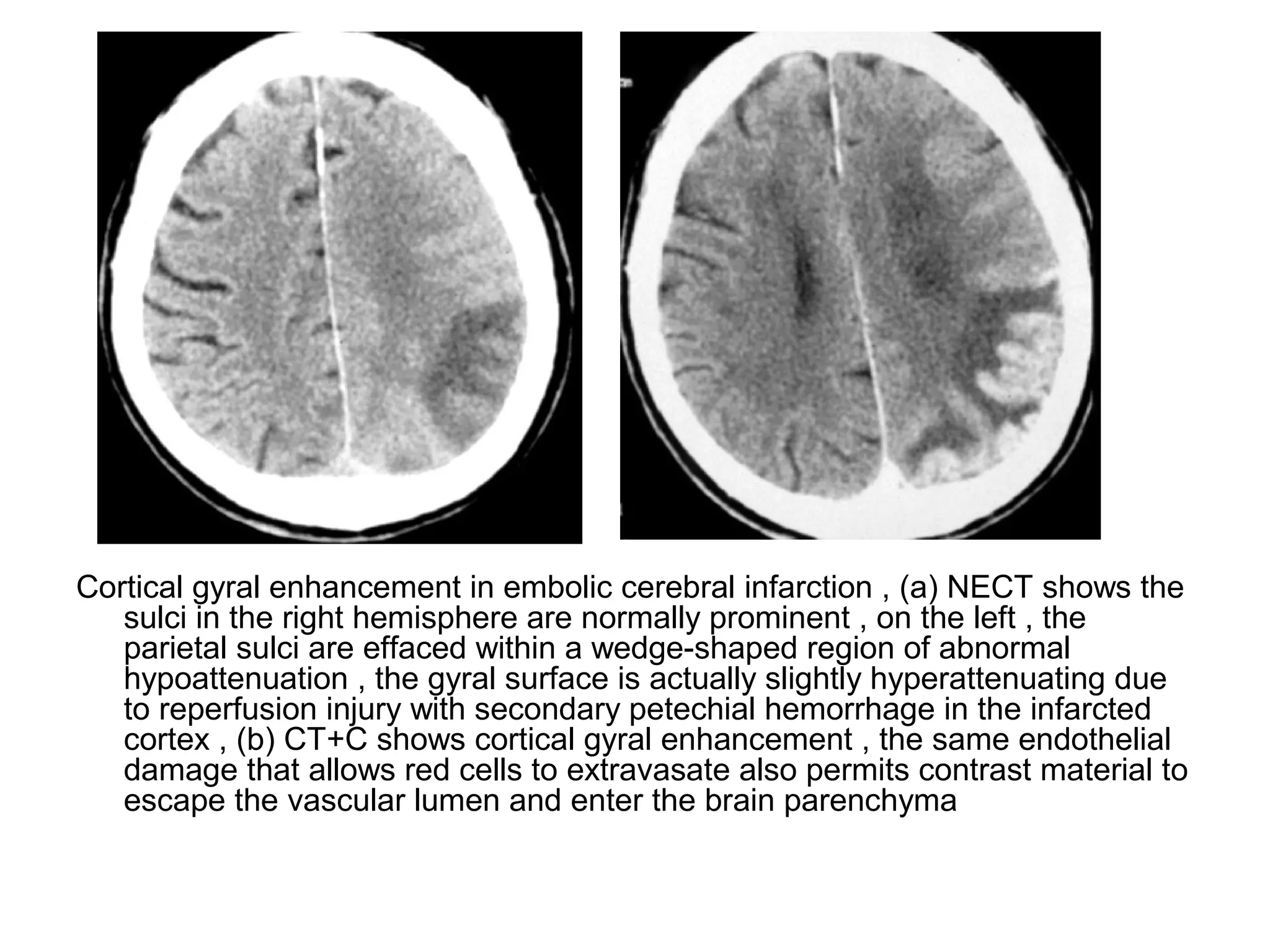 Cortical gyral enhancement in embolic cerebral infarction , (a) NECT shows the
sulci in the right hemisphere are normally prominent , on the left , the
parietal sulci are effaced within a wedge-shaped region of abnormal
hypoattenuation , the gyral surface is actually slightly hyperattenuating due
to reperfusion injury with secondary petechial hemorrhage in the infarcted
cortex , (b) CT+C shows cortical gyral enhancement , the same endothelial
damage that allows red cells to extravasate also permits contrast material to
escape the vascular lumen and enter the brain parenchyma
 