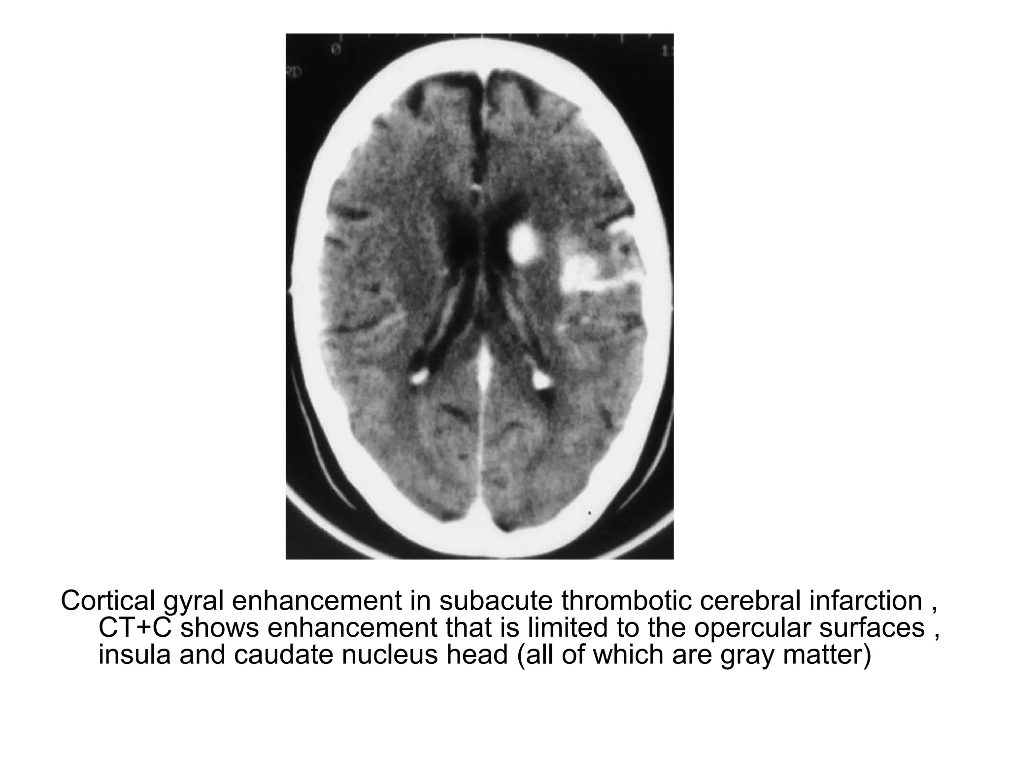 Cortical gyral enhancement in subacute thrombotic cerebral infarction ,
CT+C shows enhancement that is limited to the opercular surfaces ,
insula and caudate nucleus head (all of which are gray matter)
 