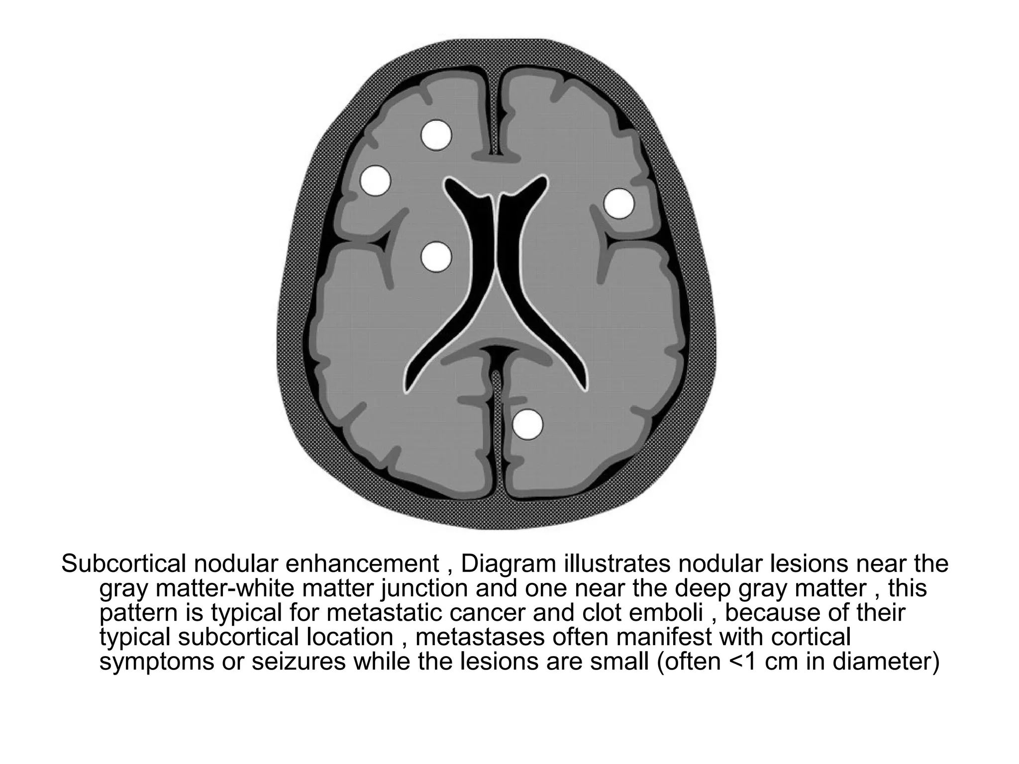 Subcortical nodular enhancement , Diagram illustrates nodular lesions near the
gray matter-white matter junction and one near the deep gray matter , this
pattern is typical for metastatic cancer and clot emboli , because of their
typical subcortical location , metastases often manifest with cortical
symptoms or seizures while the lesions are small (often <1 cm in diameter)
 