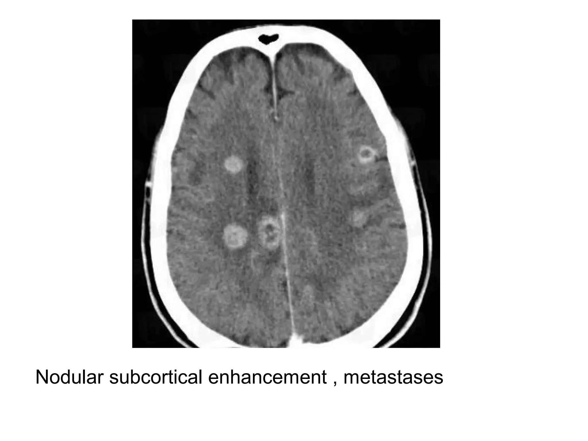 Nodular subcortical enhancement , metastases
 