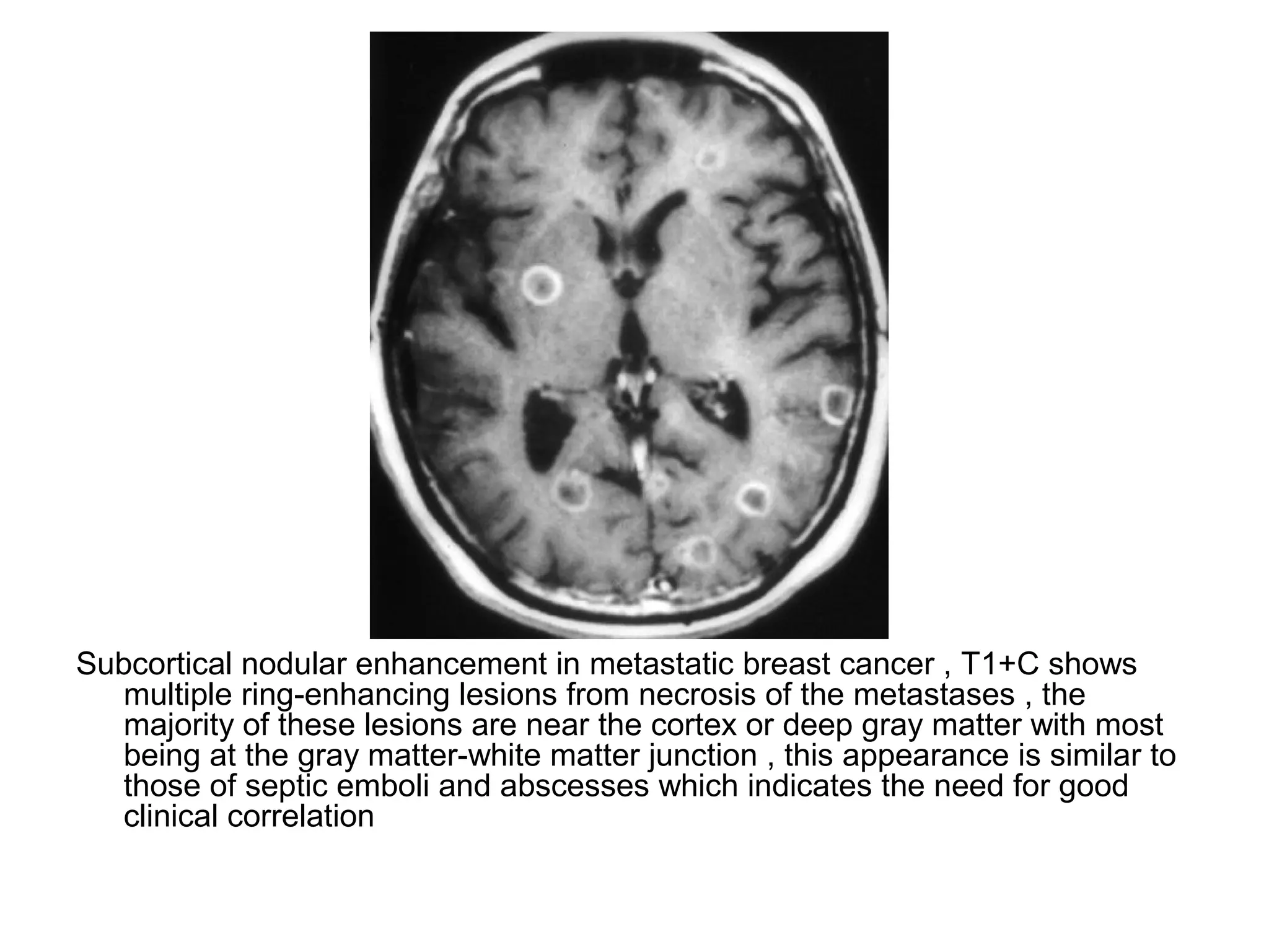 Subcortical nodular enhancement in metastatic breast cancer , T1+C shows
multiple ring-enhancing lesions from necrosis of the metastases , the
majority of these lesions are near the cortex or deep gray matter with most
being at the gray matter-white matter junction , this appearance is similar to
those of septic emboli and abscesses which indicates the need for good
clinical correlation
 