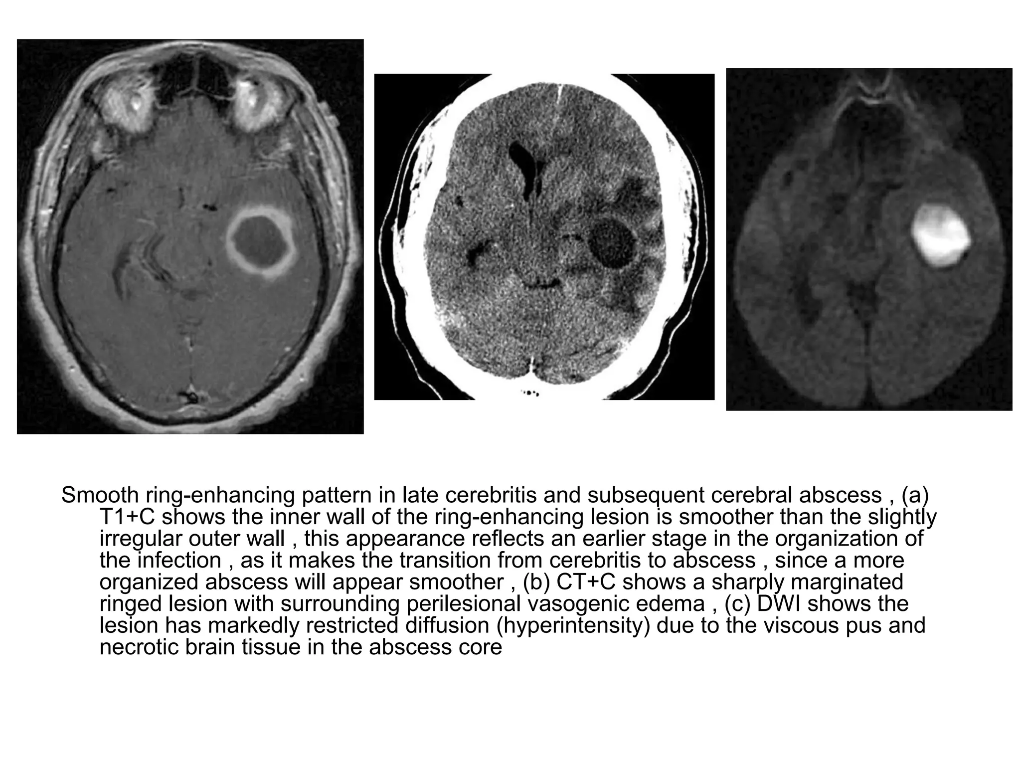 Smooth ring-enhancing pattern in late cerebritis and subsequent cerebral abscess , (a)
T1+C shows the inner wall of the ring-enhancing lesion is smoother than the slightly
irregular outer wall , this appearance reflects an earlier stage in the organization of
the infection , as it makes the transition from cerebritis to abscess , since a more
organized abscess will appear smoother , (b) CT+C shows a sharply marginated
ringed lesion with surrounding perilesional vasogenic edema , (c) DWI shows the
lesion has markedly restricted diffusion (hyperintensity) due to the viscous pus and
necrotic brain tissue in the abscess core
 