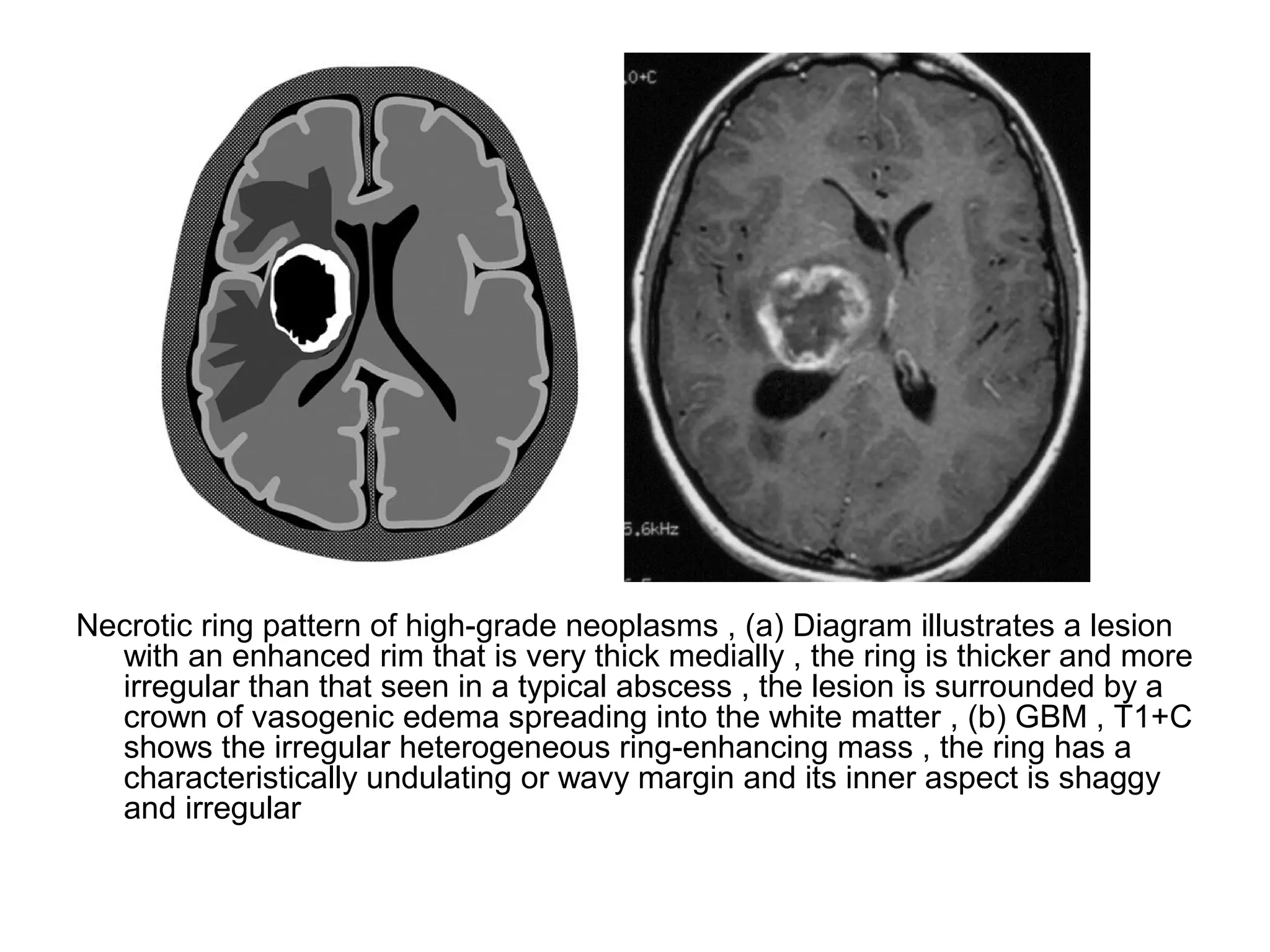Necrotic ring pattern of high-grade neoplasms , (a) Diagram illustrates a lesion
with an enhanced rim that is very thick medially , the ring is thicker and more
irregular than that seen in a typical abscess , the lesion is surrounded by a
crown of vasogenic edema spreading into the white matter , (b) GBM , T1+C
shows the irregular heterogeneous ring-enhancing mass , the ring has a
characteristically undulating or wavy margin and its inner aspect is shaggy
and irregular
 