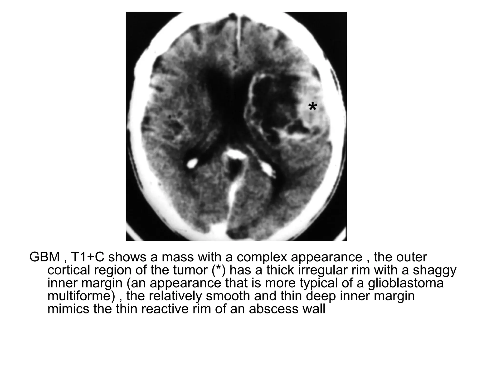 GBM , T1+C shows a mass with a complex appearance , the outer
cortical region of the tumor (*) has a thick irregular rim with a shaggy
inner margin (an appearance that is more typical of a glioblastoma
multiforme) , the relatively smooth and thin deep inner margin
mimics the thin reactive rim of an abscess wall
 