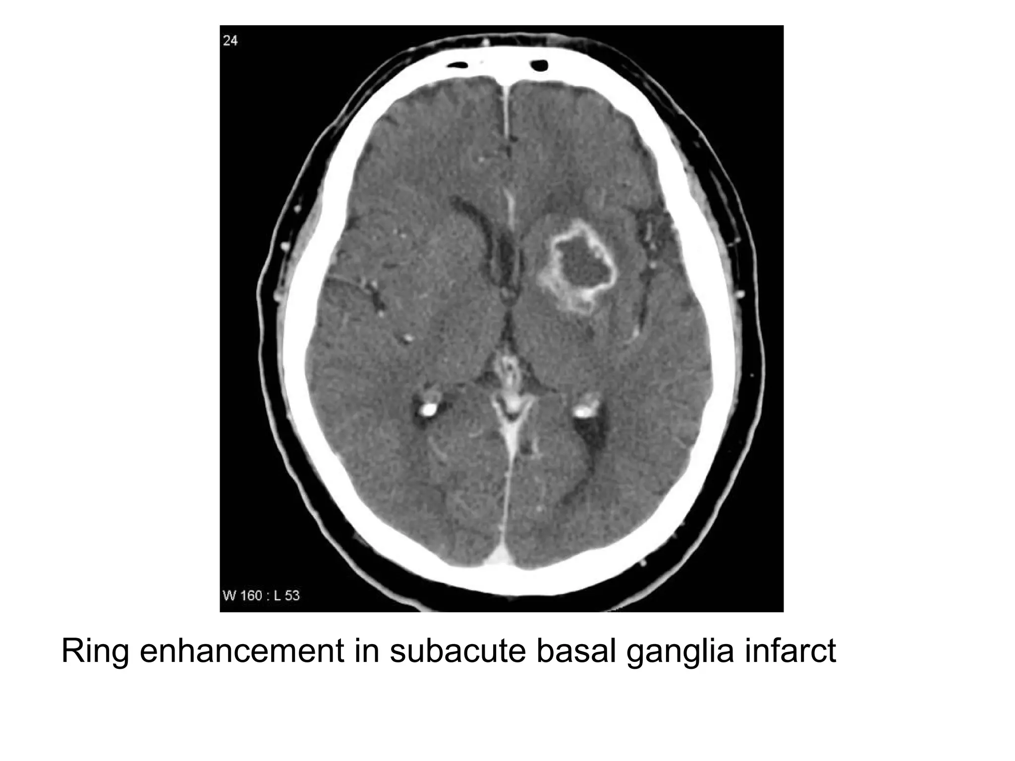 Ring enhancement in subacute basal ganglia infarct
 